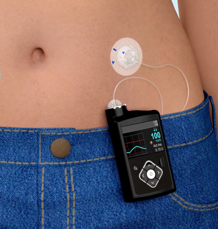 How Do Insulin Pump Brands Compare? Find Yours