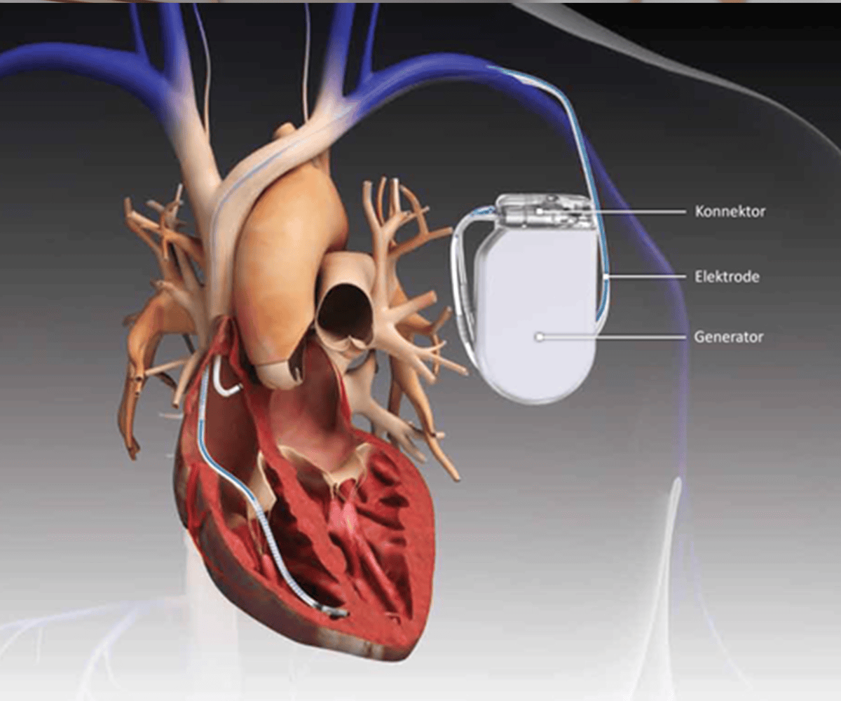 Who Needs A Pacemaker Understanding The Indications And Benefits Of